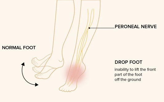 Understanding Foot Drop & Foot Drop Rehabilitation